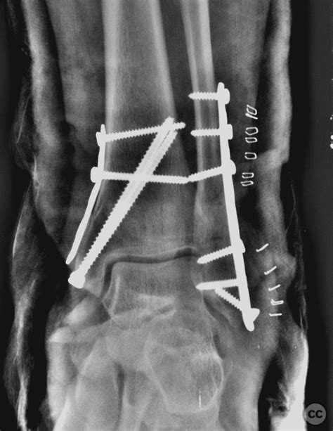 Compound Fracture Dislocation Of Left Ankle