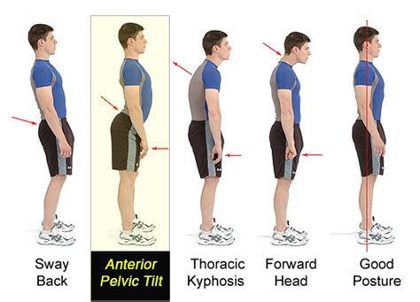 What Is A Pelvic Tilt Body Focus Physiotherapy