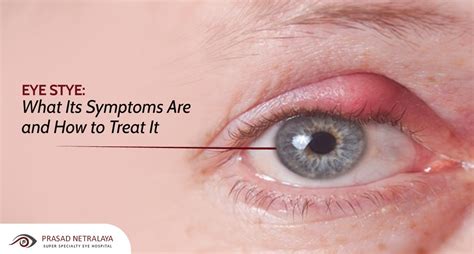 What Causes Styes In The Eye Prasad Netralaya