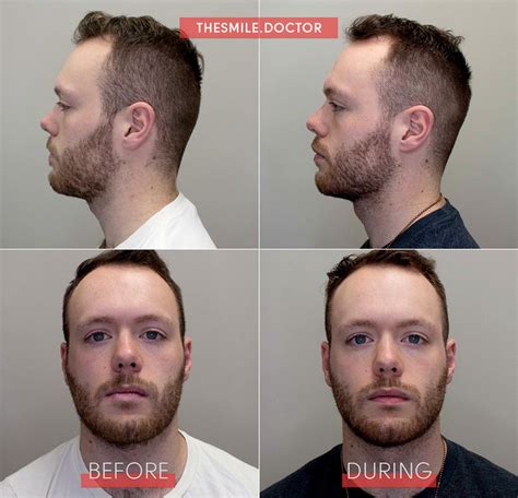 Check spelling or type a new query. Pin on jaw, palate, face reshaping without surgery