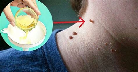 How To Remove Fibroma And Other Skin Warts All By Yourself | Skin tags ...