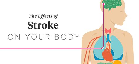 Stroke Why More Middle Aged Adults Are Having It And How To Prevent