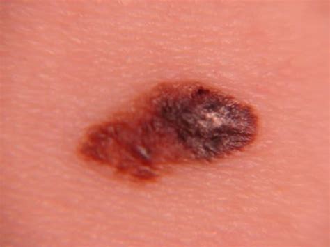 Melanoma Skin Cancer Is Deadly Identify The Signs Early To Save Your Life
