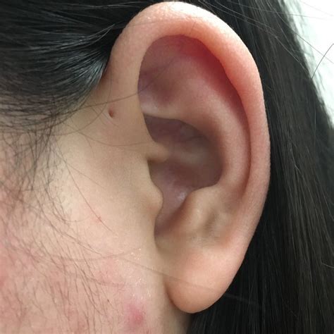 A Small Percentage Of People Are Born With Tiny Holes In Their Ears