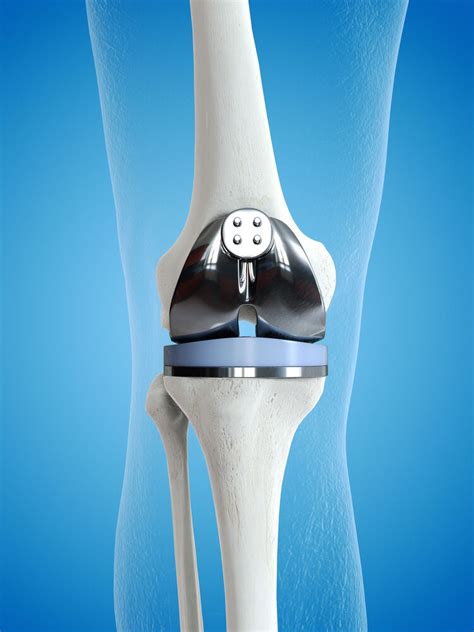 Florida Total Joint Replacement Hernando Orthopedic And Spinal Surgery