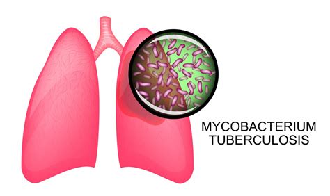 Similarities Between Sarcoidosis And Tuberculosis Make Diagnosis Difficult
