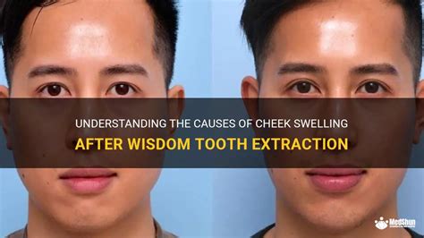 Understanding The Causes Of Cheek Swelling After Wisdom Tooth
