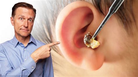 What Does Lots Of Earwax Buildup Mean Youtube