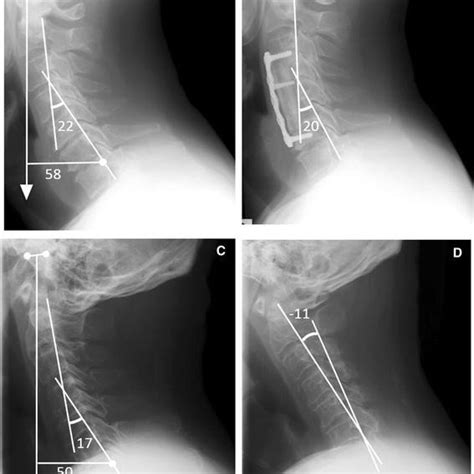 Radiographic Measurements A Cl Cervical Lordosis C27 Lordotic