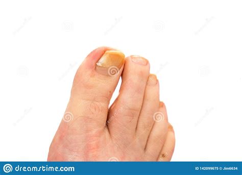 Untreated Toenail Fungal Infection On The Big Or Main Toe Of The Right