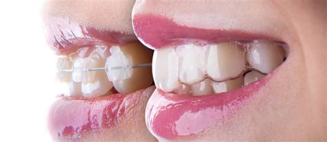 Your initial retainers can last anywhere from two to ten years, depending on how well you take care of them. How Long Do You Have To Wear Invisalign Aligners - How ...