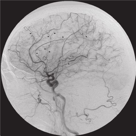 Cerebral Angiography Of The Left Common Carotid Artery Revealed Several