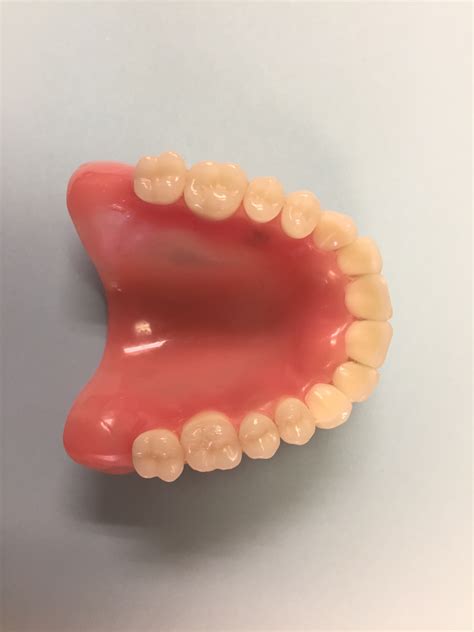 Maxillary Partial Denture Inwood Dental Pc