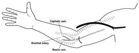 Transposition Of The Basilic Vein For Arteriovenous Fistula An
