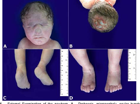 PDF Alobar Holoprosencephaly And Trisomy 13 Patau Syndrome
