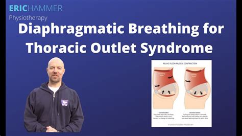 Diaphragmatic Breathing For Thoracic Outlet Syndrome Youtube