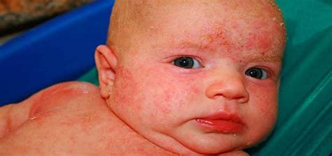 Psoriasis In Children Treatment Symptoms And Causes Celebrities Funda