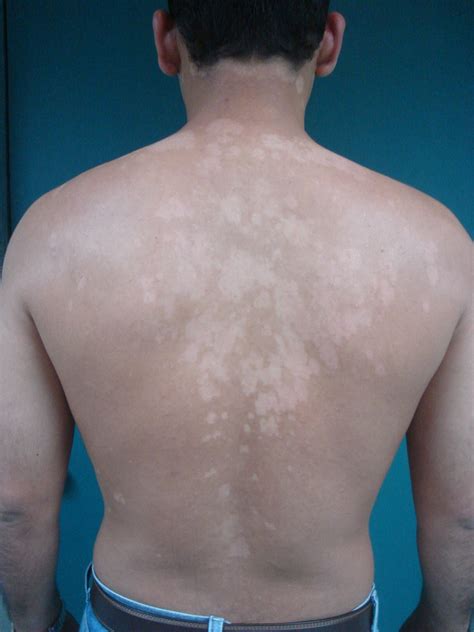 Pityriasis versicolor is a skin condition that can be the source of both discomfort and embarrassment. La Dermatosis de la Semana: Pitiriasis versicolor