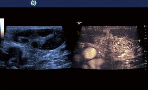 New Ultrasound Techniques For Lymph Node Evaluation