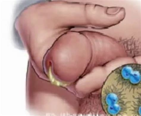 Uretritis Escozor Al Orinar Y Secreci N Uretral Por Clamidia O Gonorrea