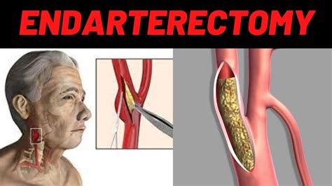 What Is Endarterectomy Carotid Endarterectomy Surgery Indications