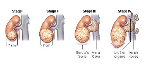 People with kidney cancer may experience the following symptoms or signs. Kidney Health | Kidney Cancer Treatment Singapore ...