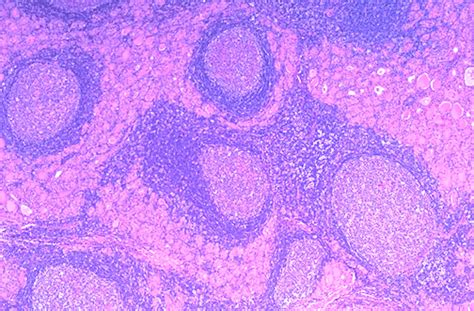 Pathology Outlines Hashimoto Thyroiditis