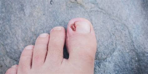 Is That A Staph Infection Dealing With An Infected Ingrown Toenail
