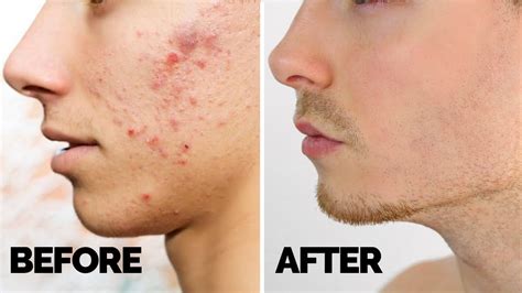 Pimples On Face Removal Tips For Men