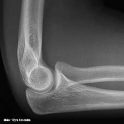 Normal Paediatric Elbow Anatomy Wikiradiography