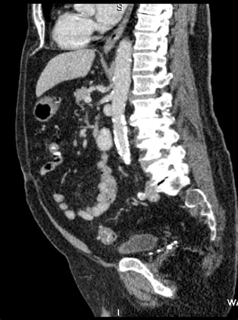 Sagittal Abdomen 2 Diagram Quizlet