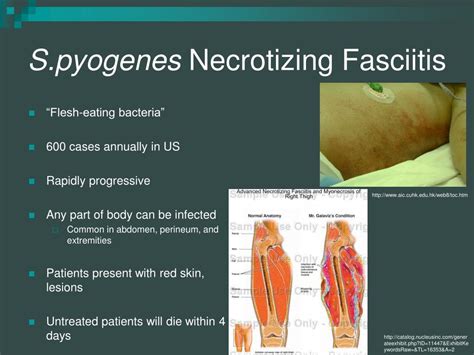 PPT - Streptococcus pyogenes PowerPoint Presentation - ID ...