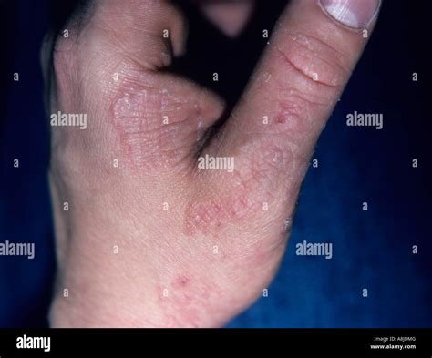 Fungus Infection Called Tinea Manus On The Hand Also Known As Ringworm