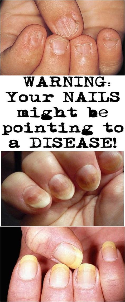 Warning Your Nails Might Be Pointing To A Disease You Nailed It
