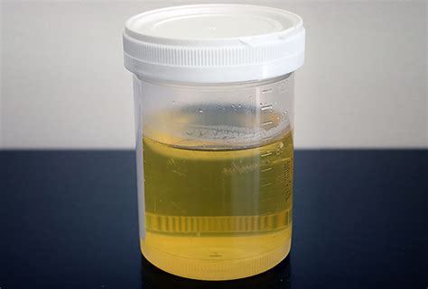 Teste De Urina Pode Detectar Câncer De Pâncreas Precocemente