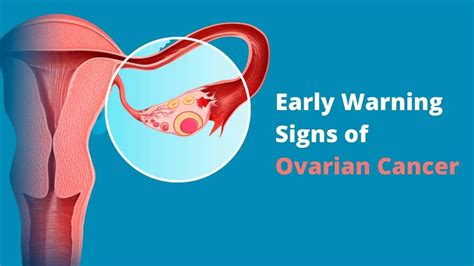 Ovarian Cancer Early Signs Symptoms Risks And Treatment
