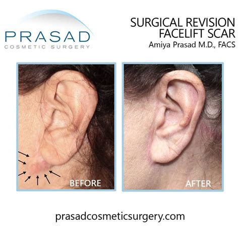 Facelift Scars How They Can Be Minimized Dr Prasad Blog