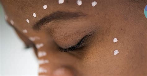 The Ultimate Guide To Acne For Dark Skin Glamour Uk