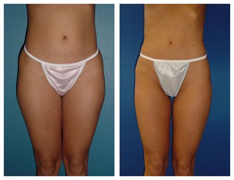 Female Inner Outer Thighs Liposuction By Dr William Hall Before And