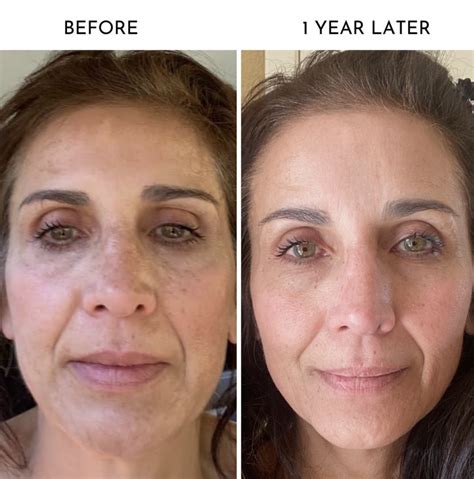 Microneedling Before And After Tips For Ultimate Transformation Hot Queen