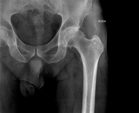 Dislocation is a condition that happens when the bones of a joint are knocked out of place. Hip replacement surgery in Marbella | Dr. Ignatios ...
