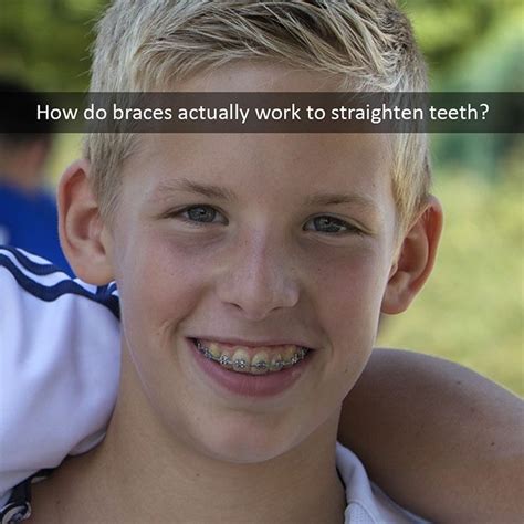 How Do Braces Actually Work Beach Orthodontics