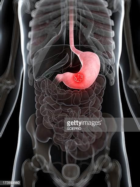 Stomach Cancer Photos And Premium High Res Pictures Getty Images