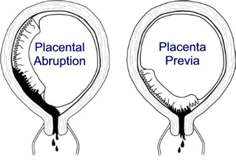 Find out how you'll know if you have placenta previa and what happens if it persists. 전치태반 Placenta previa & 태반조기박리 abruptio placenta : 네이버 블로그