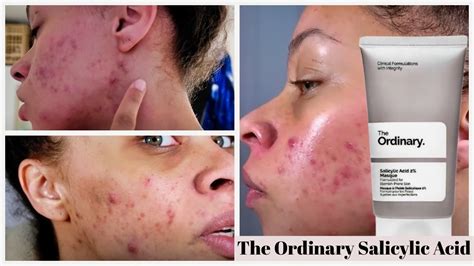 The Ordinary Salicylic Acid Acne Prone Skin Youtube