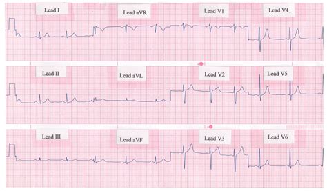 Lead Surface Electrocardiogram Ecg Of Typical Atrial Flutter The Best