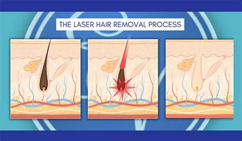 how does laser hair removal work en vogue medi spa