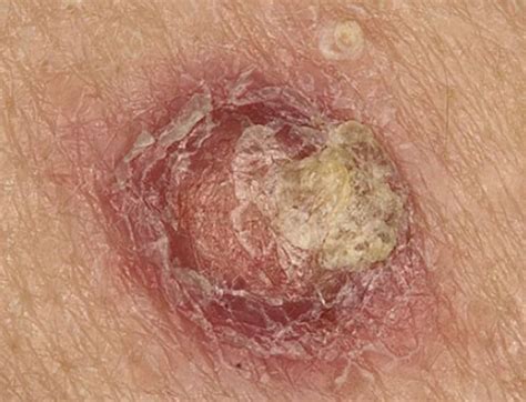 Itchy Mole Causes Cancer Advice Breast Face Back Harmless