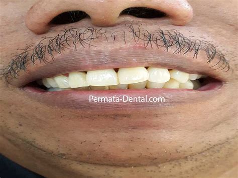 Maybe you would like to learn more about one of these? Ahli Gigi Bali | Permata Dental: Merapikan Gigi Yang Maju ...