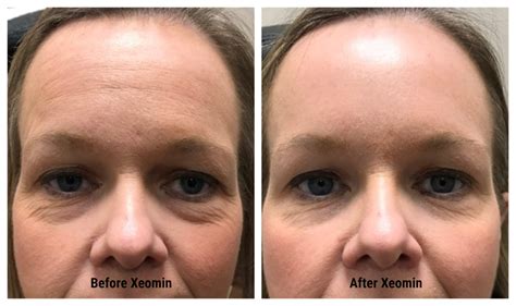 Gallery Oculoplastic Oculofacial Plastic Surgery By Dr Jenna Kim